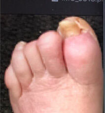 Diabetic Foot Ulcer/Hammertoe
