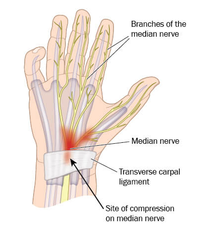 carpal tunnel syndrome diagram