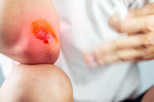Speed Up the Wound Healing Process with FIR Therapy