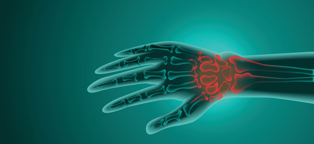 Why Consider Having A Wrist Therapy Device | Gladiator Therapeutics