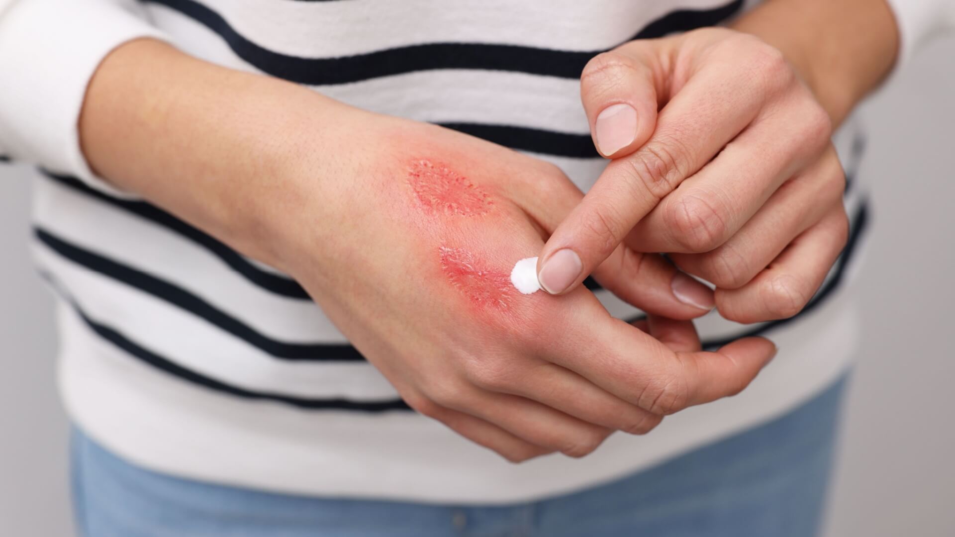 Healing Scars