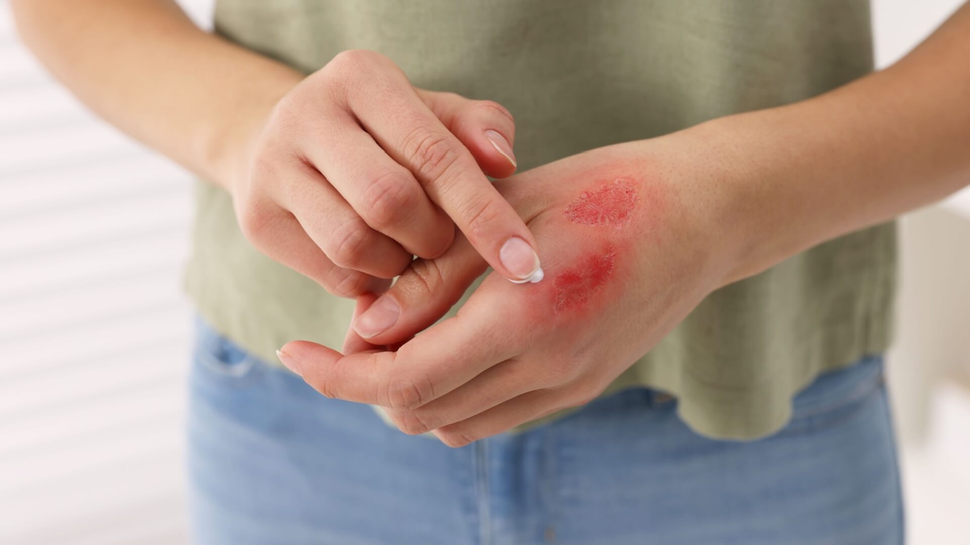 burn injuries
