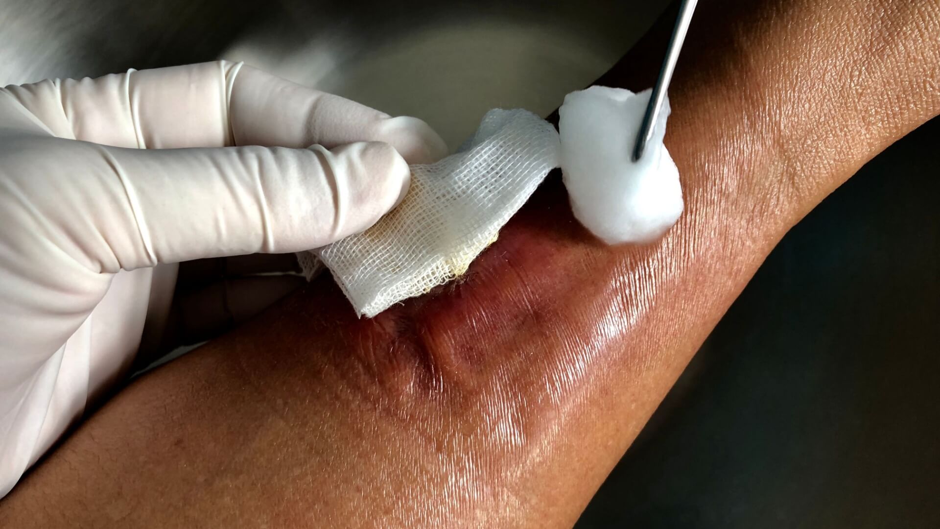 types of wound drainage